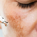Tratamiento Facial Antimanchas
