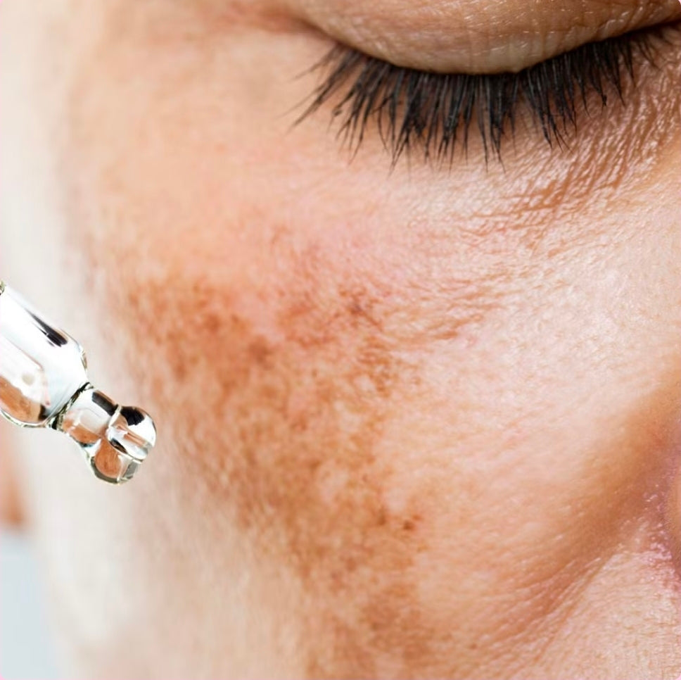 Tratamiento Facial Antimanchas