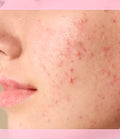 Tratamiento Facial Antiacné