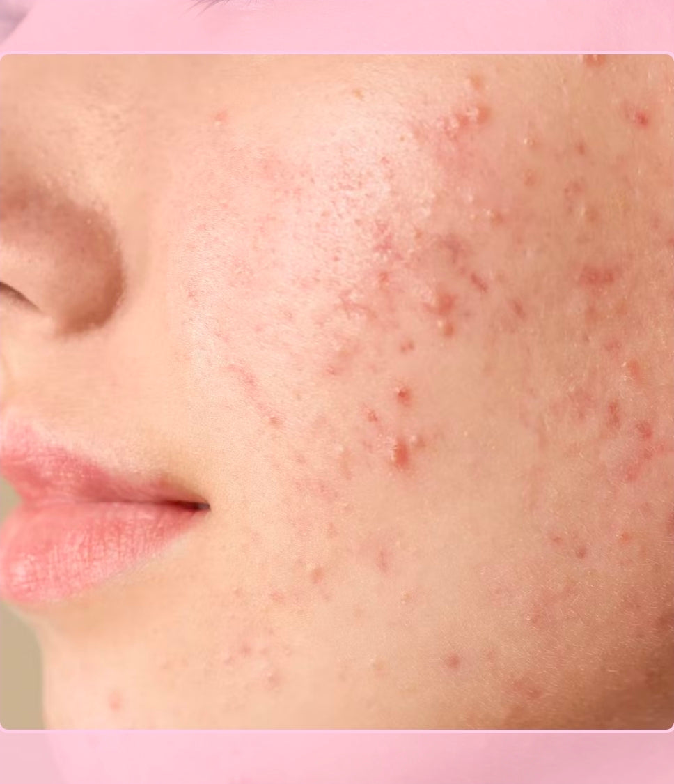 Tratamiento Facial Antiacné