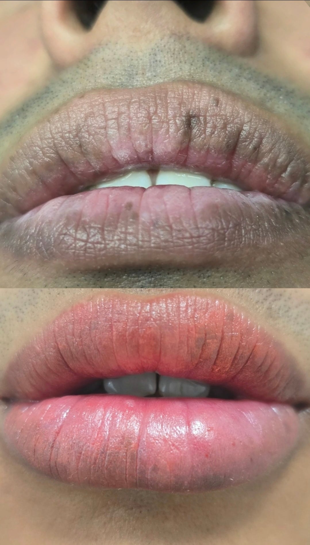 Neutralización de labios